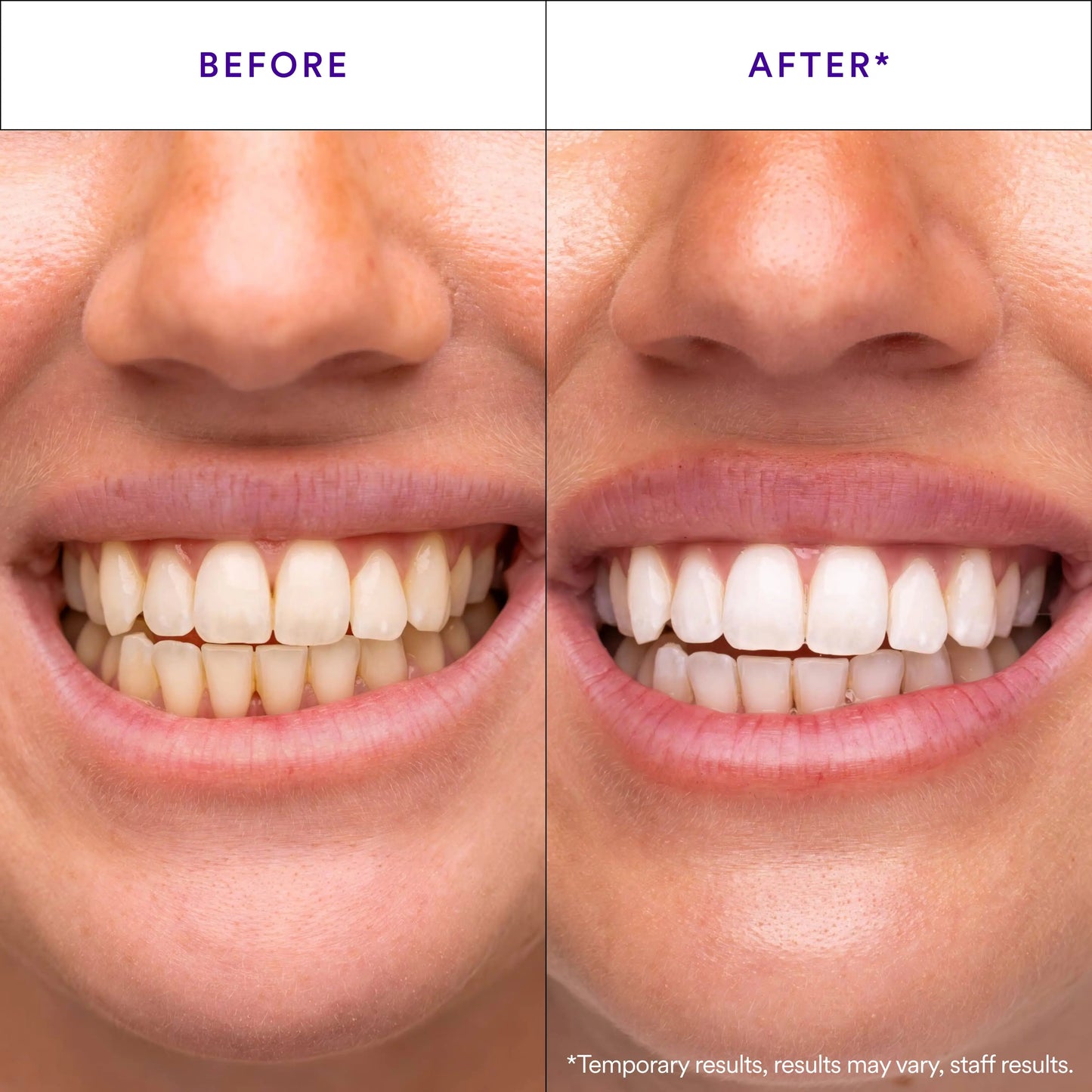 HiSmile V34 Teeth Whitening Strips – 14 Applications -A0025