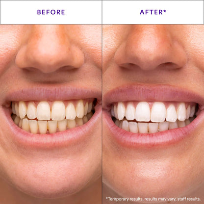 HiSmile V34 Teeth Whitening Strips – 14 Applications -A0025